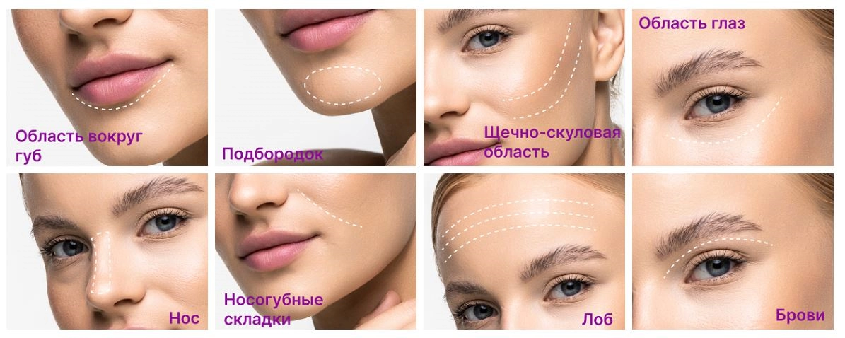 Зоны применения нитей